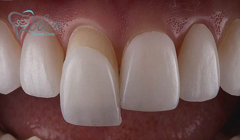 علت برداشتن لمینت دندان
